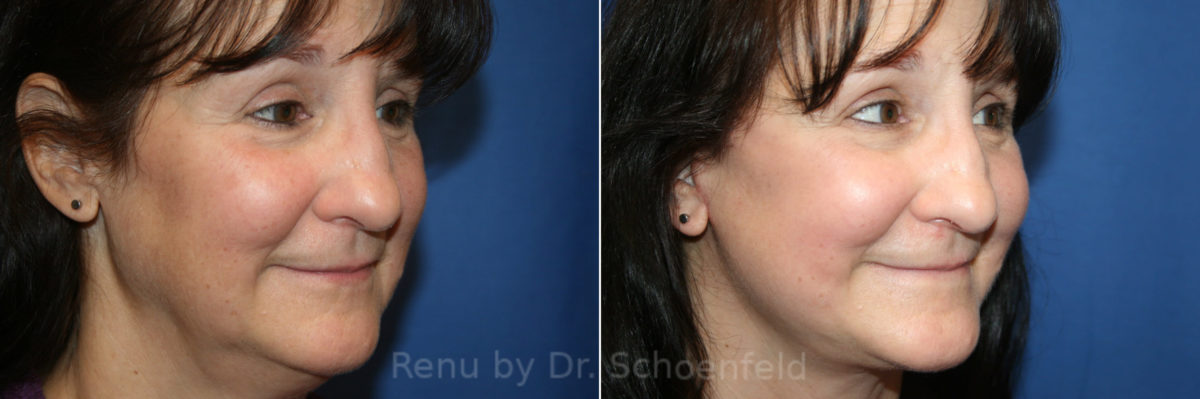 Facelift Before and After Photos in DC, Patient 13982