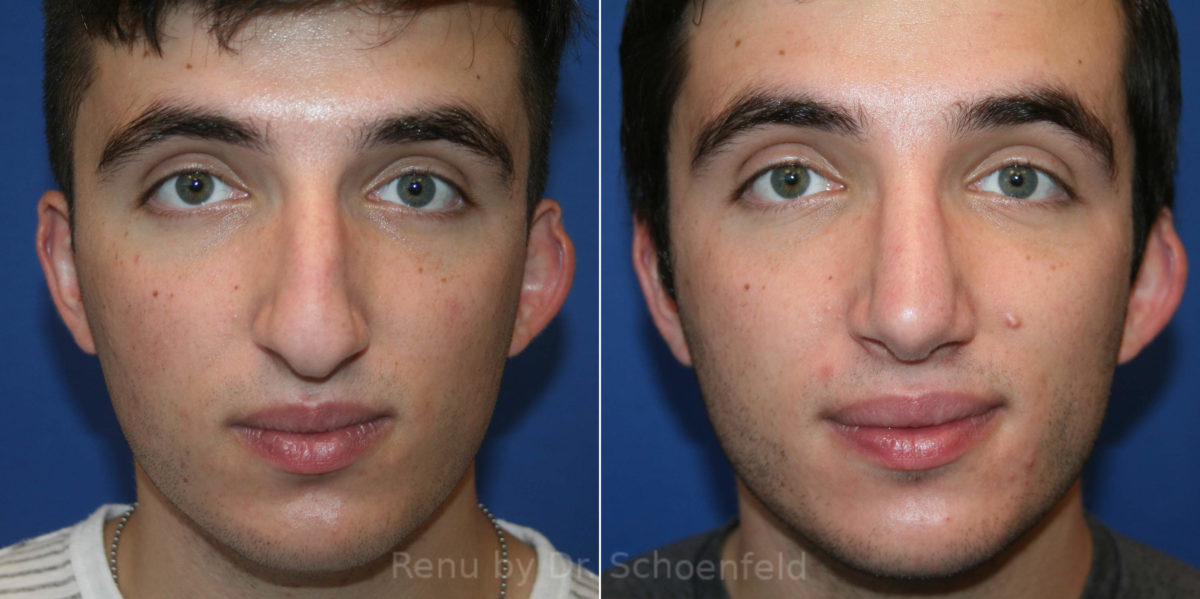 Rhinoplasty Before and After Photos in DC, Patient 14077