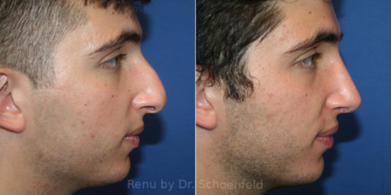 Rhinoplasty Before and After Photos in DC, Patient 14077