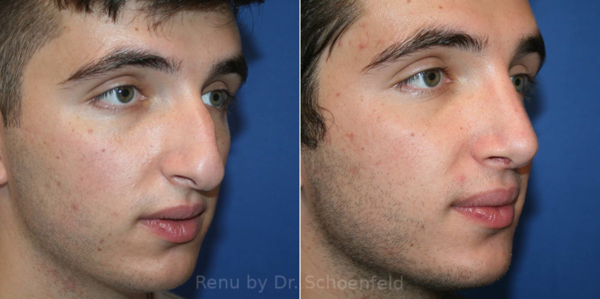 Rhinoplasty Before and After Photos in DC, Patient 14077