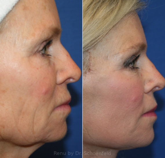 Facelift Before and After Photos in DC, Patient 14149