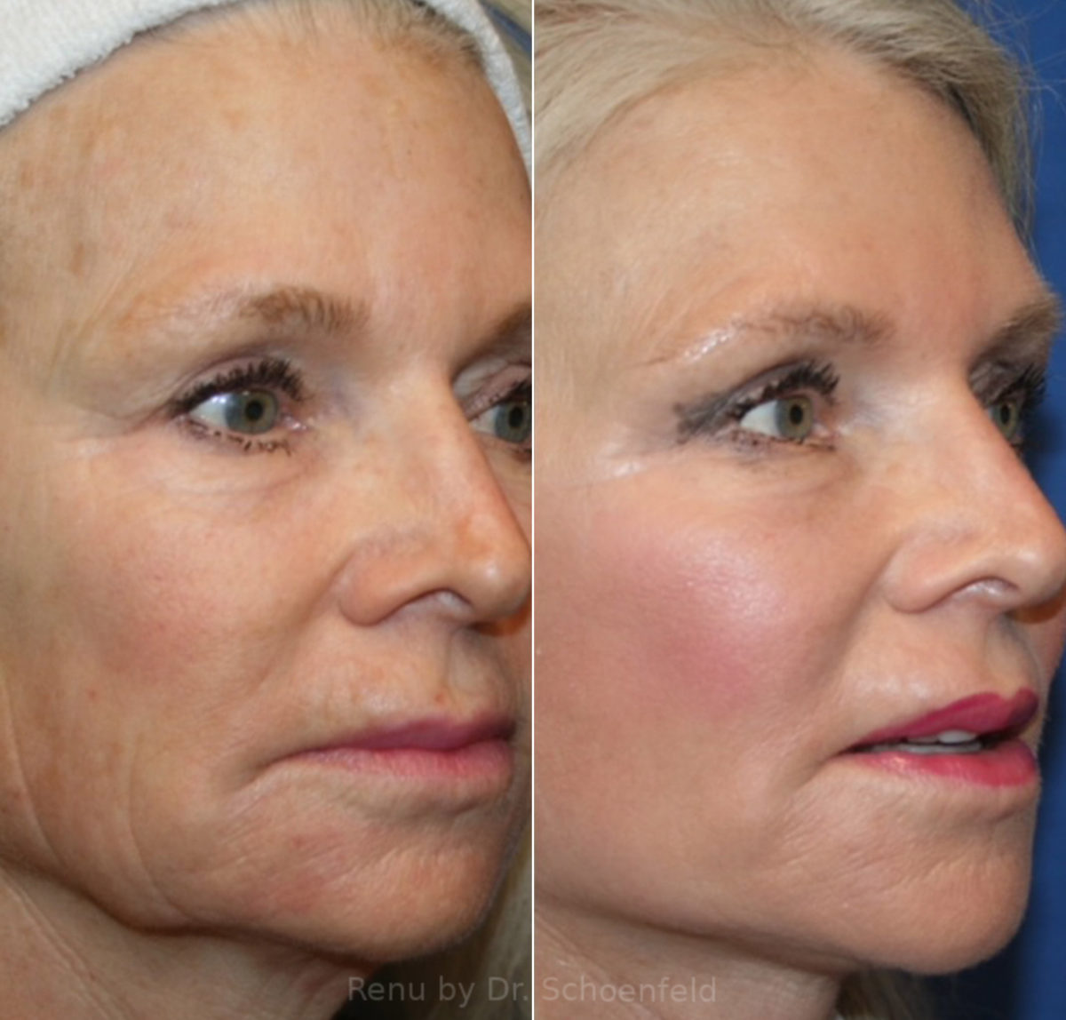 Facelift Before and After Photos in DC, Patient 14149
