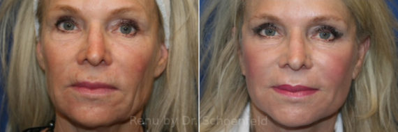 Facelift Before and After Photos in DC, Patient 14149