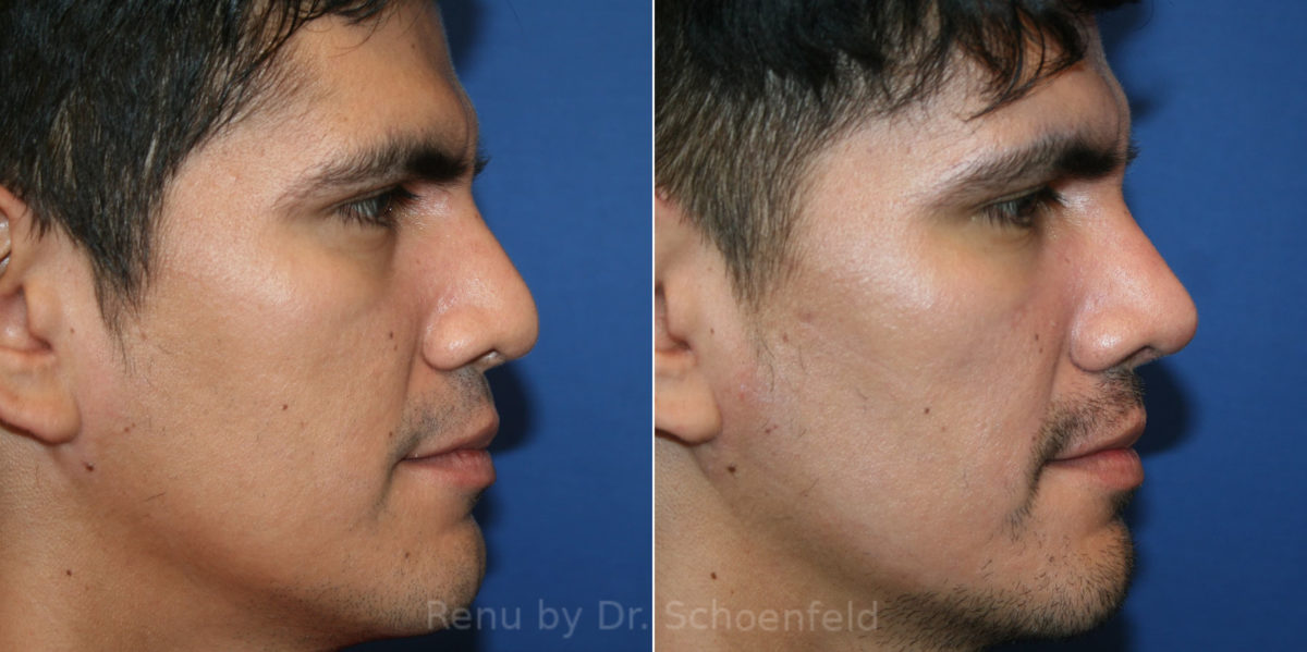 Rhinoplasty Before and After Photos in DC, Patient 14173