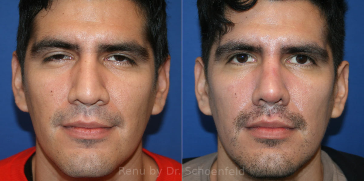 Rhinoplasty Before and After Photos in DC, Patient 14173