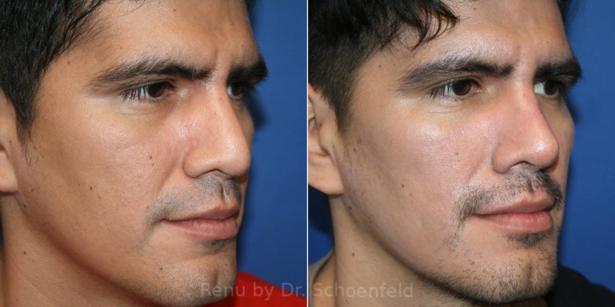Rhinoplasty Before and After Photos in DC, Patient 14173