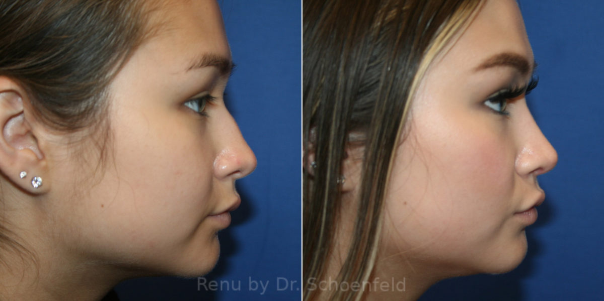 Rhinoplasty Before and After Photos in DC, Patient 14191
