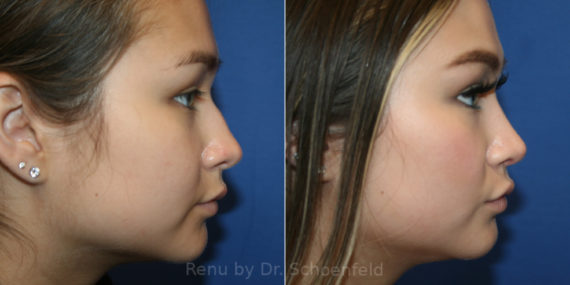 Rhinoplasty Before and After Photos in DC, Patient 14191