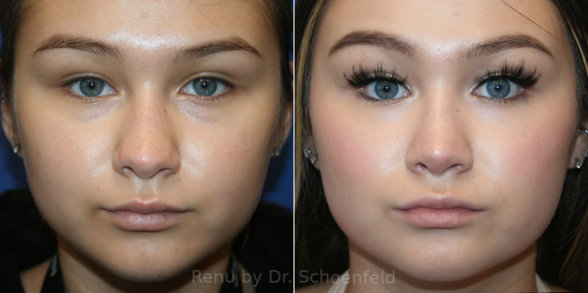 Rhinoplasty Before and After Photos in DC, Patient 14191