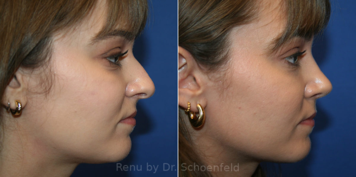 Rhinoplasty Before and After Photos in DC, Patient 14192