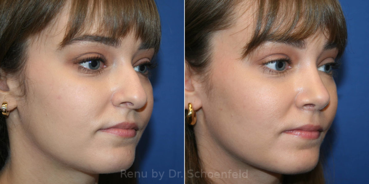 Rhinoplasty Before and After Photos in DC, Patient 14192