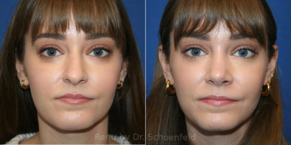 Rhinoplasty Before and After Photos in DC, Patient 14192