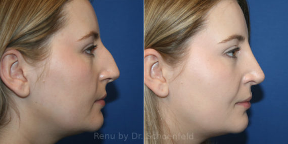 Rhinoplasty Before and After Photos in DC, Patient 14213