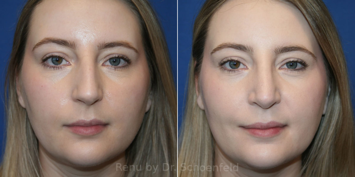 Rhinoplasty Before and After Photos in DC, Patient 14213