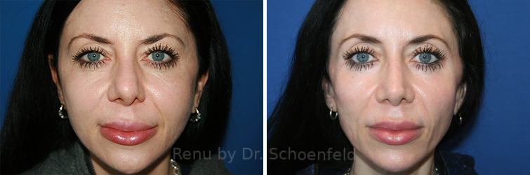 Revision Rhinoplasty Before and After Photos in DC, Patient 14225