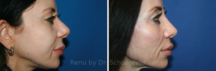 Revision Rhinoplasty Before and After Photos in DC, Patient 14225