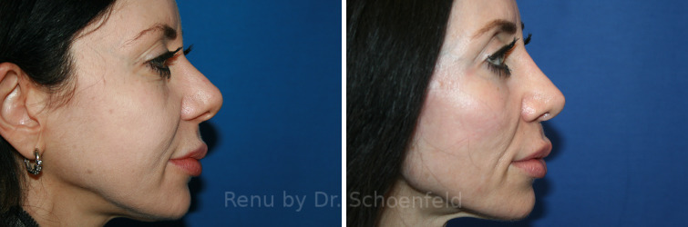Patient 14225, Revision Rhinoplasty Before and After Photos Revision Rhinoplasty Before and After Photos in DC, Patient 14225