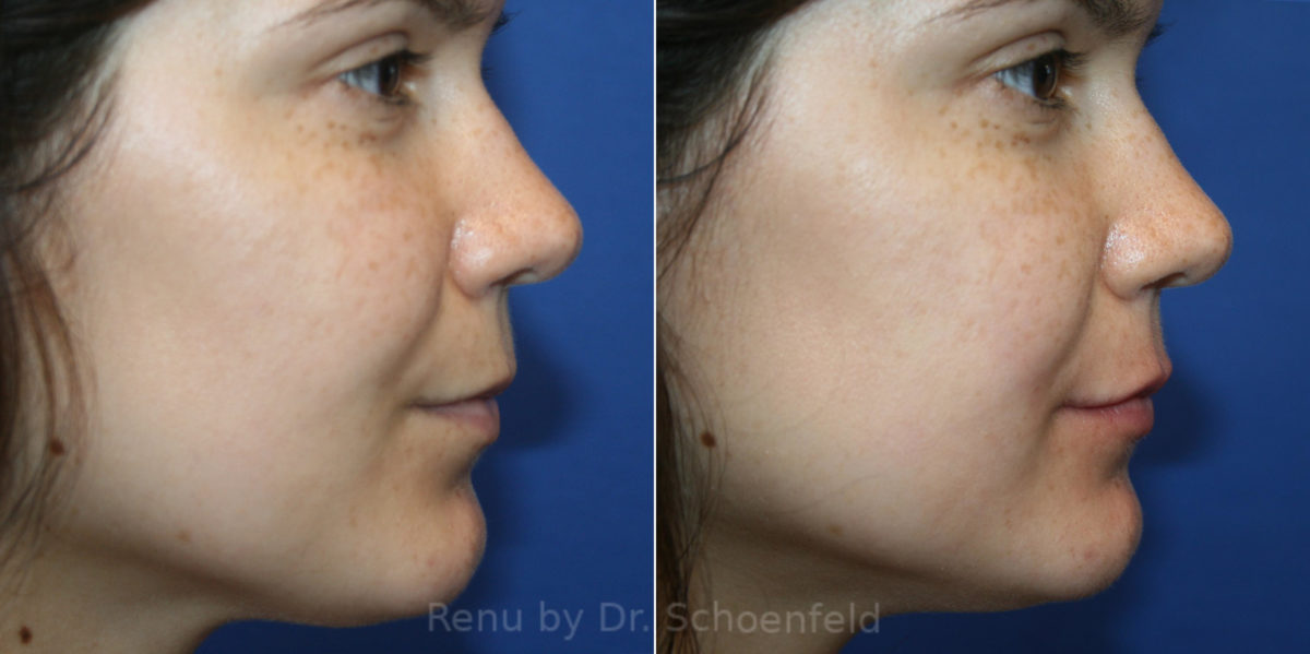 Dermal Filler Before and After Photos in DC, Patient 14235