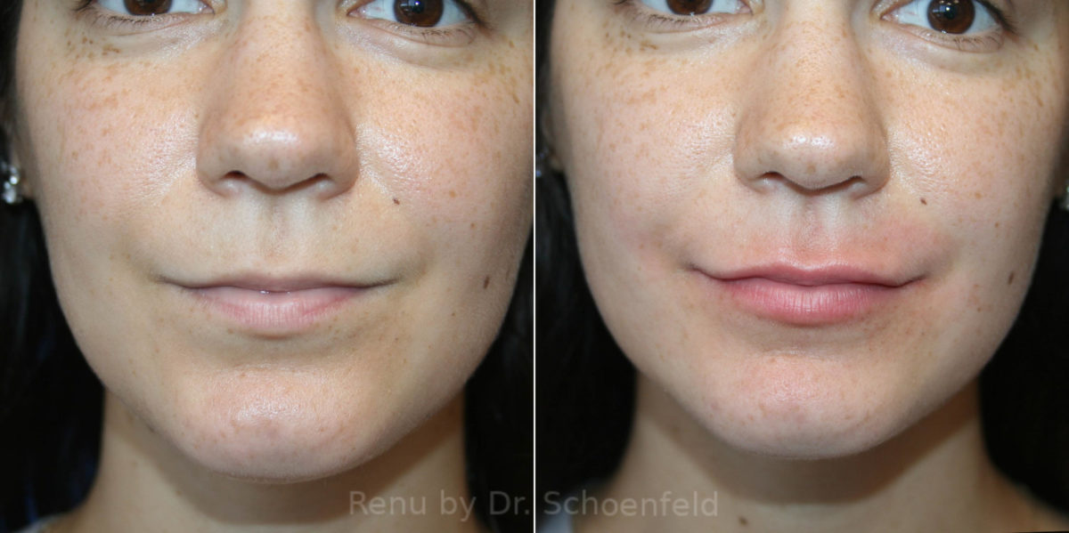 Dermal Filler Before and After Photos in DC, Patient 14235