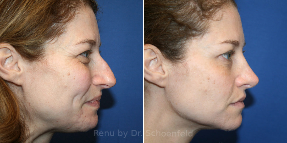 Rhinoplasty Before and After Photos in DC, Patient 14274