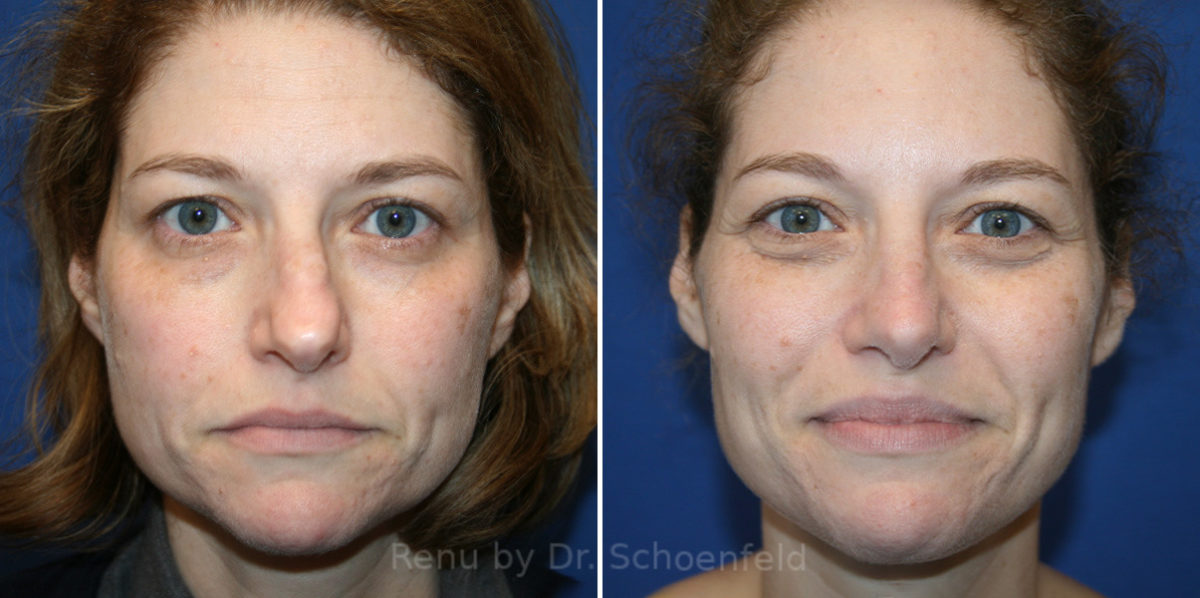 Rhinoplasty Before and After Photos in DC, Patient 14274