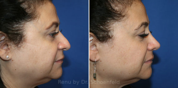 Rhinoplasty Before and After Photos in DC, Patient 14283