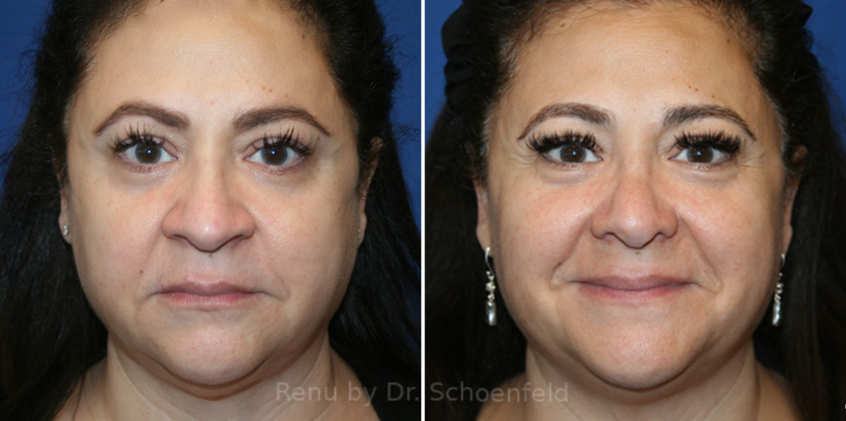 Rhinoplasty Before and After Photos in DC, Patient 14283