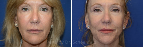 Facelift Before and After Photos in DC, Patient 21688561