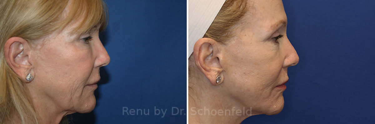 Facelift Before and After Photos in DC, Patient 21688561