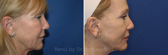 Facelift Before and After Photos in DC, Patient 21688561