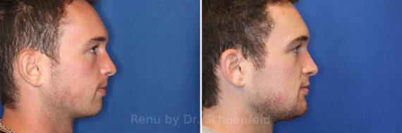 Chin Implant Before and After Photos in DC, Patient 14322