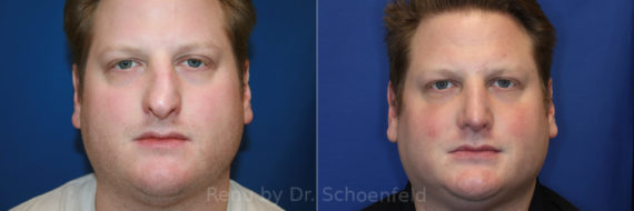 Rhinoplasty Before and After Photos in DC, Patient 14371