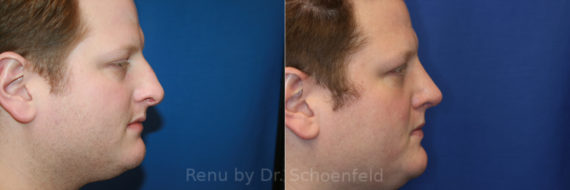 Rhinoplasty Before and After Photos in DC, Patient 14371