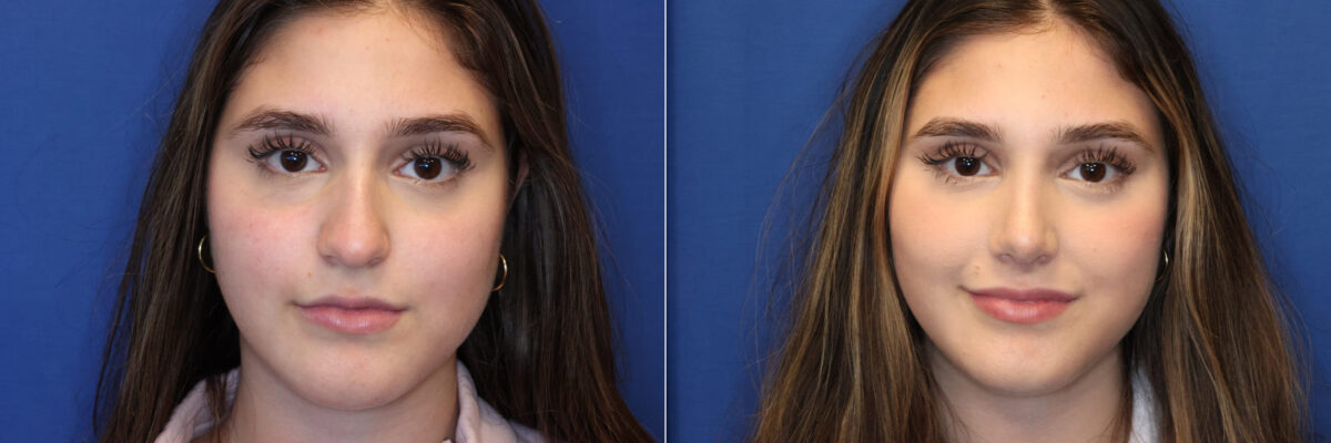 Rhinoplasty Before and After Photos in DC, Patient 14429