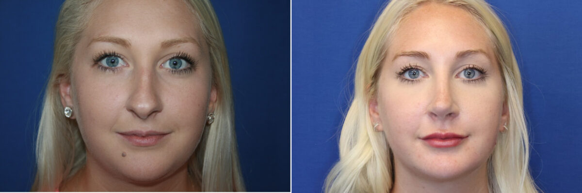 Rhinoplasty Before and After Photos in DC, Patient 14452
