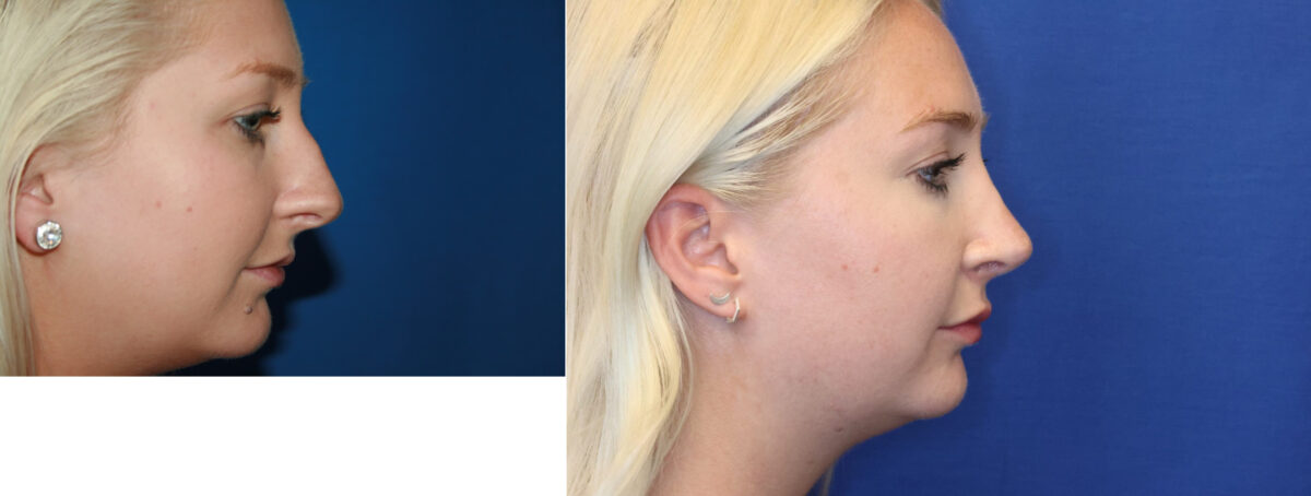 Rhinoplasty Before and After Photos in DC, Patient 14452