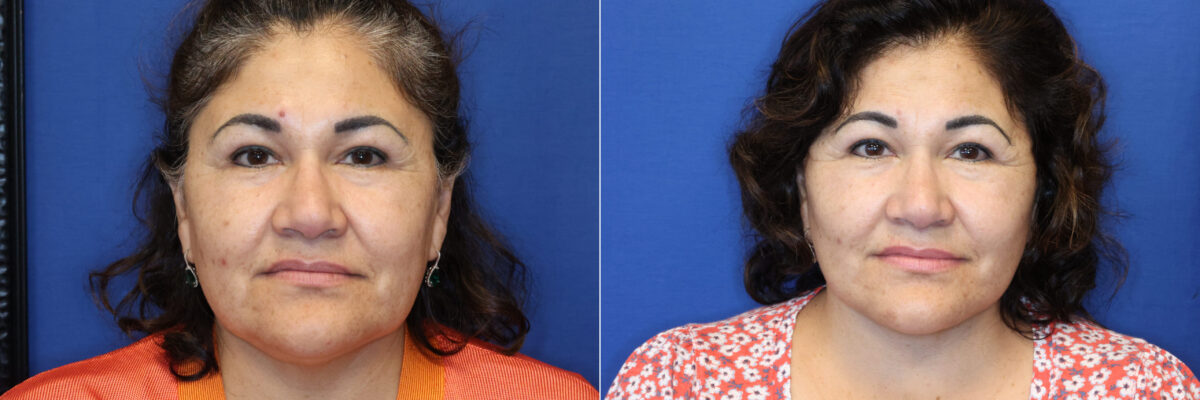 Facelift Before and After Photos in DC, Patient 14467