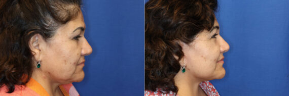 Facelift Before and After Photos in DC, Patient 14467