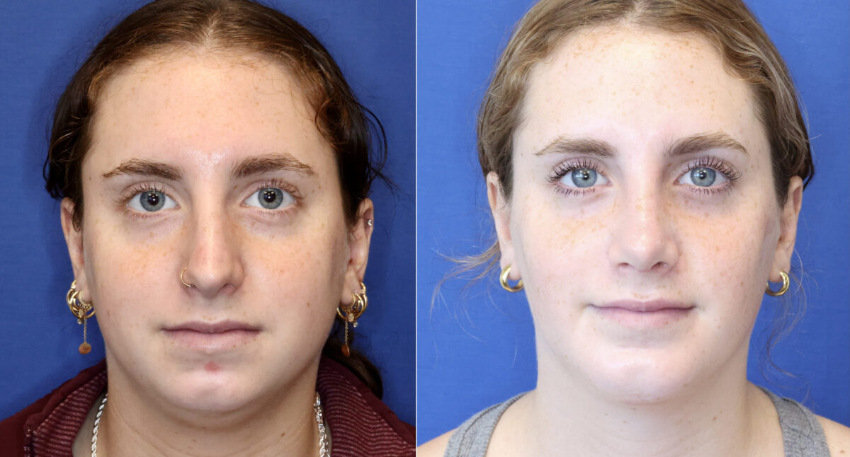 Buccal Fat Removal Before and After Photos in DC, Patient 14485