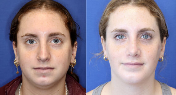 Rhinoplasty Before and After Photos in Chevy Chase, MD