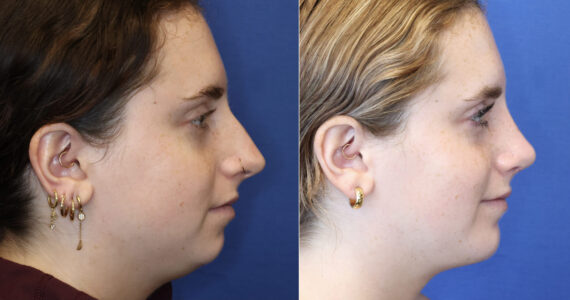 buccal Fat Removal Before and After Photos in DC, Patient 14485