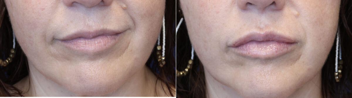 Dermal Filler Before and After Photos in DC, Patient 14500