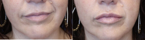 Dermal Filler Before and After Photos in DC, Patient 14500