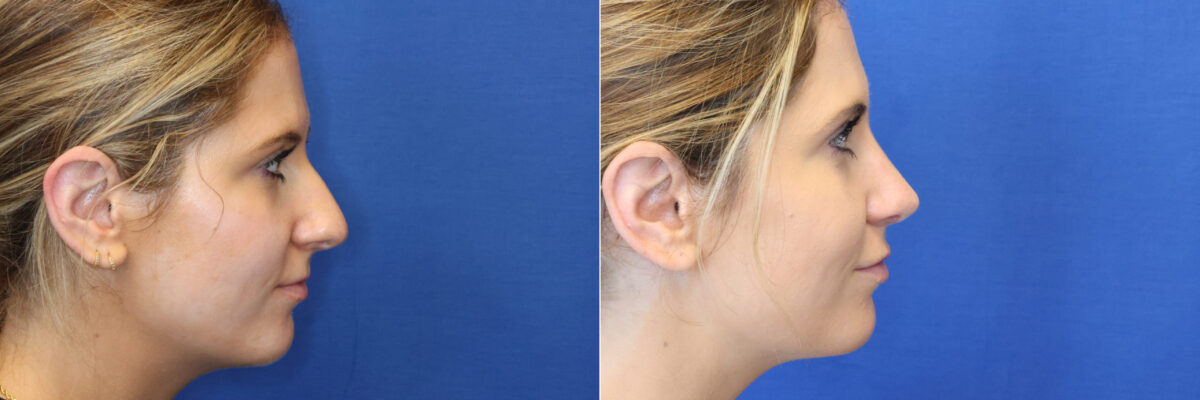 Rhinoplasty Before and After Photos in DC, Patient 14504