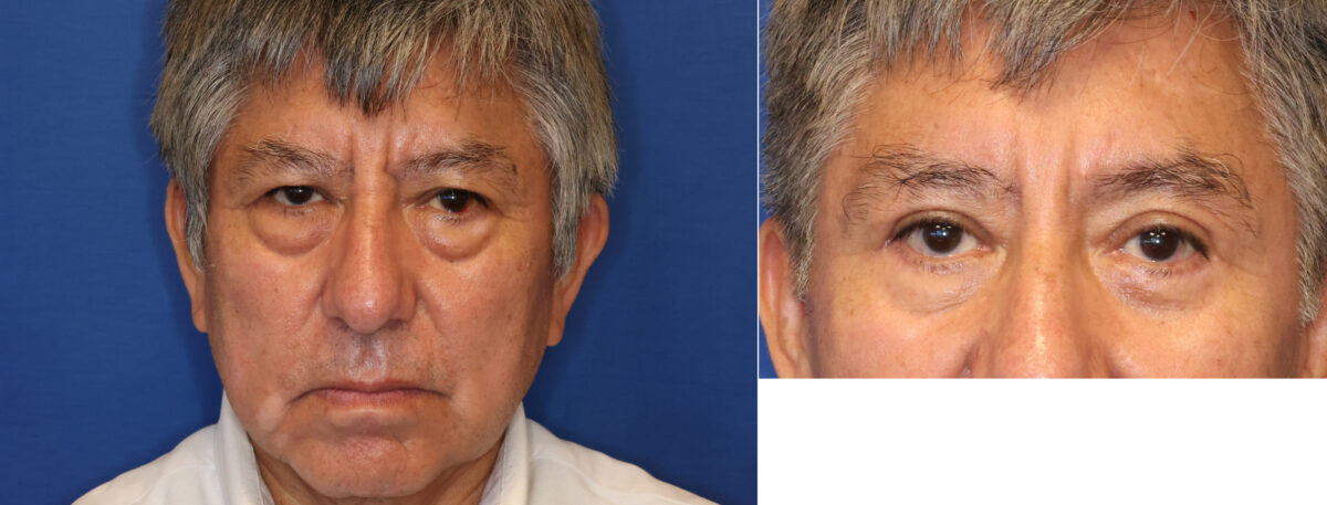 Blepharoplasty Before and After Photos in DC, Patient 14549