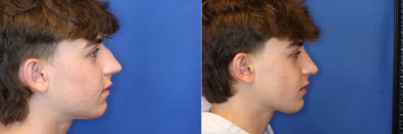 Rhinoplasty Before and After Photos in DC, Patient 14554