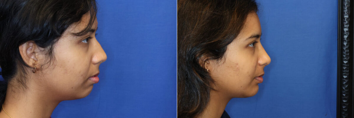 buccal Fat Removal Before and After Photos in DC, Patient 14559