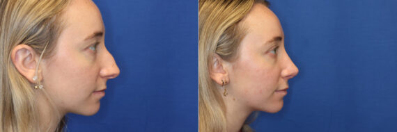 Rhinoplasty Before and After Photos in DC, Patient 14690