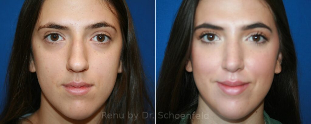 Rhinoplasty Before After Scaled