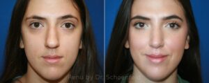 Rhinoplasty Before After Scaled